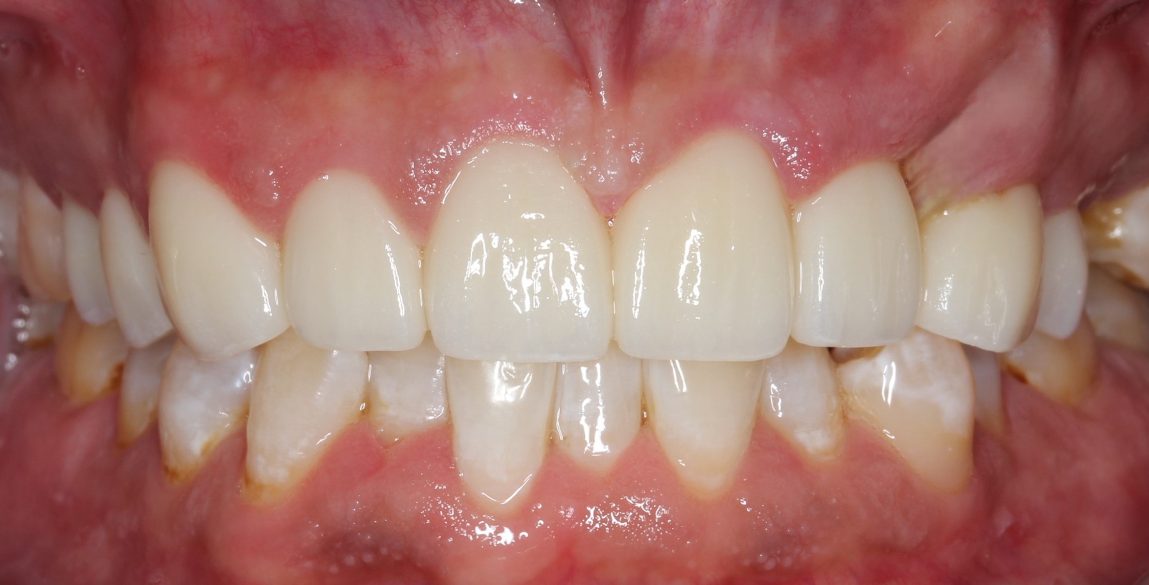  dental veneers Phuket, best dentist in Phuket, dentist Phuket, veneers Phuket